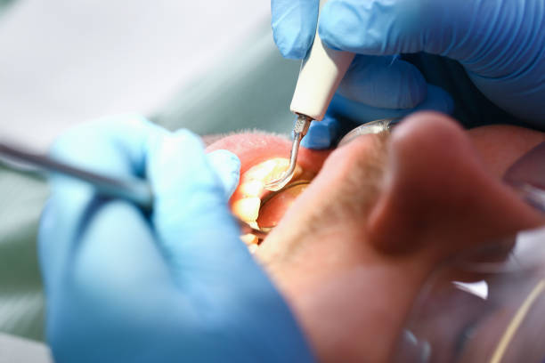 Best Emergency Tooth Extraction in Peru, IL