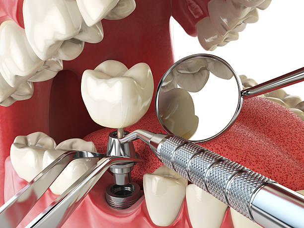 Best Emergency Tooth Extraction in Peru, IL
